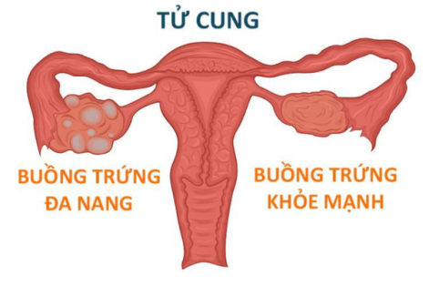 Đa Nang Buồng Trứng, Nguyên Nhân Và Cách Hỗ Trợ Điều Trị Hiệu Quả