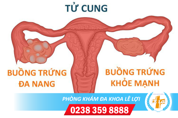 Đa Nang Buồng Trứng, Nguyên Nhân Và Cách Hỗ Trợ Điều Trị Hiệu Quả