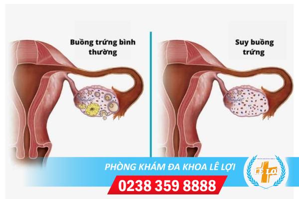 Bạn Có Biết Suy Buồng Trứng Sớm Là Gì Không?