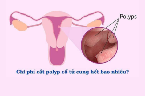 Chi phí chữa trị bệnh polyp cổ tử cung bao nhiêu