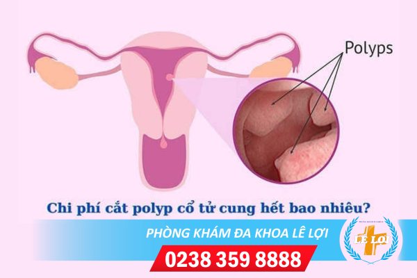 Chi phí chữa trị bệnh polyp cổ tử cung bao nhiêu