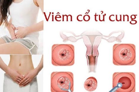 Những Tác Hại Của Bệnh Viêm Cổ Tử Cung Và Cách Điều Trị