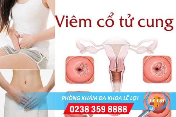 Địa chỉ khám viêm cổ tử cung hiệu quả uy tín