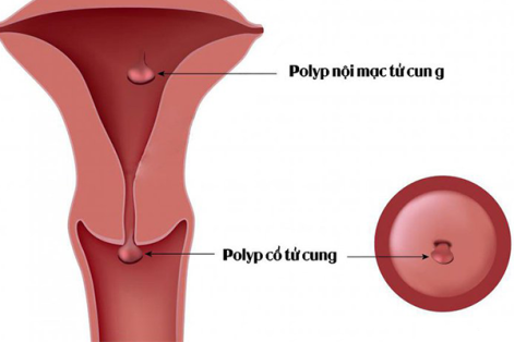 Polyp Cổ Tử Cung Là Căn Bệnh Như Thế Nào Và Những Điều Cần Chú Ý