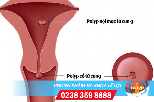 Polyp Cổ Tử Cung Là Căn Bệnh Như Thế Nào Và Những Điều Cần Chú Ý