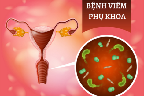 Dấu hiệu bệnh viêm nhiễm phụ khoa