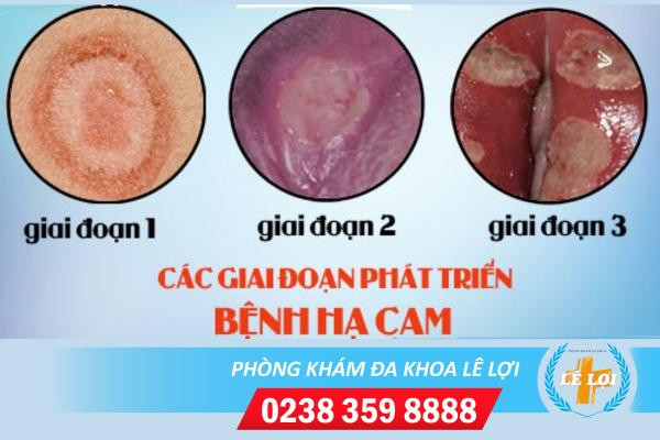 Bệnh hạ cam mềm và những điều cần biết