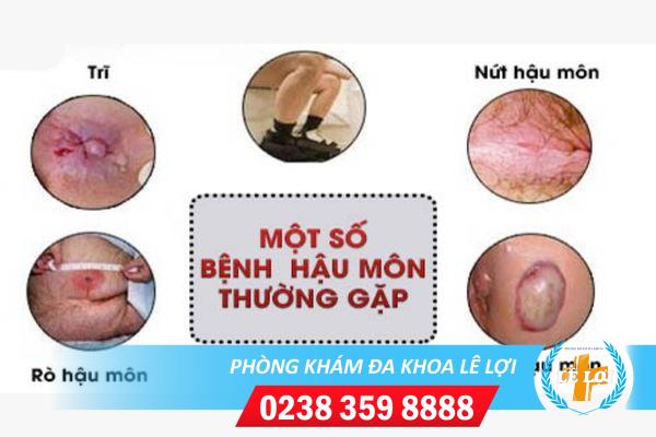 Địa chỉ chữa bệnh hậu môn uy tín tại Vinh – Nghệ An