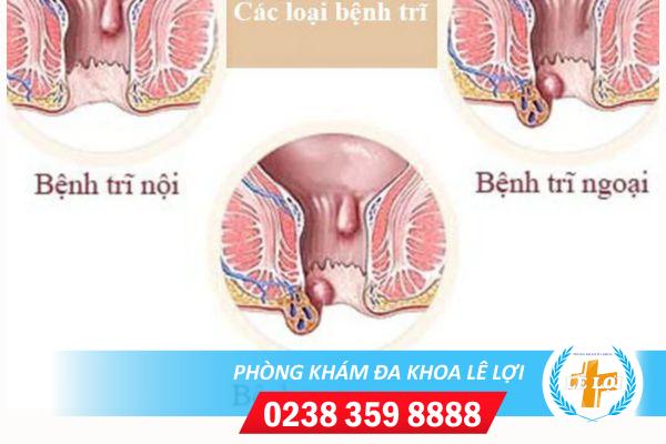 Địa chỉ điều trị bệnh trĩ uy tín tại thành phố Vinh – Nghệ An