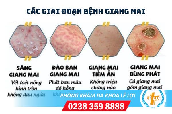 cac-giai-doan-benh-benh-giang-mai