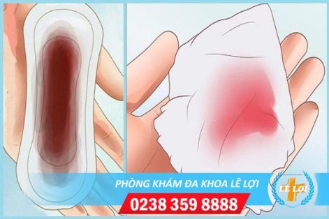 Thủ phạm khiến kinh nguyệt ra nhiều