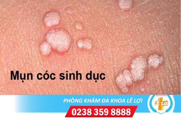 Mụn cóc sinh dục là bệnh gì ?