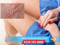 Nguyên nhân gây nổi mụn ở âm đạo