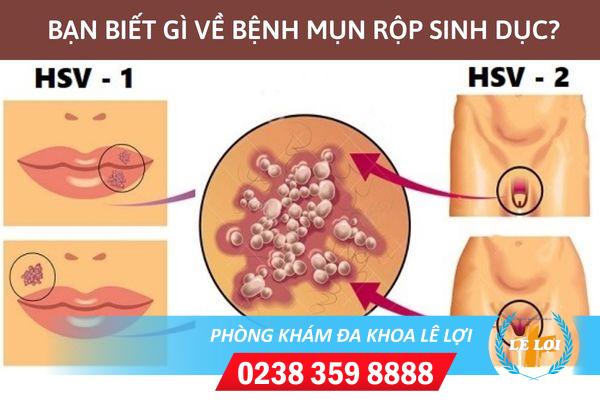Hỗ trợ điều trị mụn rộp sinh dục bằng những phương pháp nào?