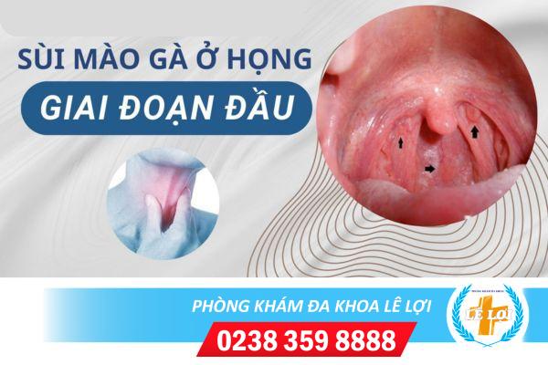 Sùi mào gà ở họng