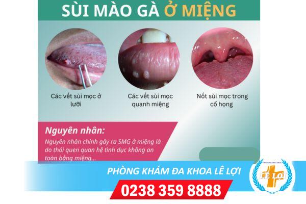 Phải làm gì khi bị sùi mào gà ở miệng