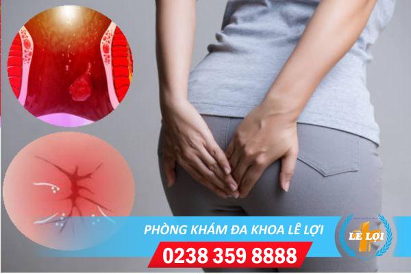 Sưng hậu môn là triệu chứng bệnh gì ?