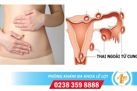 Dấu hiệu chửa ngoài tử cung chị em nên biết