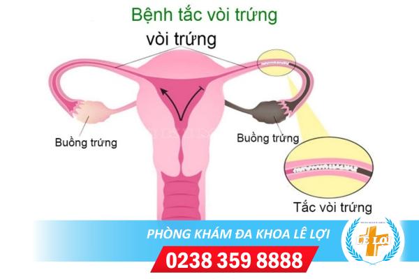 Thông tắc vòi trứng an toàn