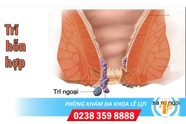 Dấu hiệu và cách điều bệnh trị trĩ hỗn hợp hiệu quả