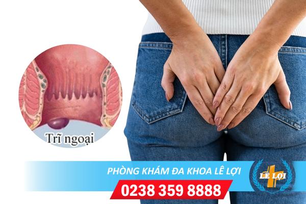 Bệnh Trĩ Ngoại – Mối Nguy Hiểm Khôn Lường Đối Với Sức Khỏe