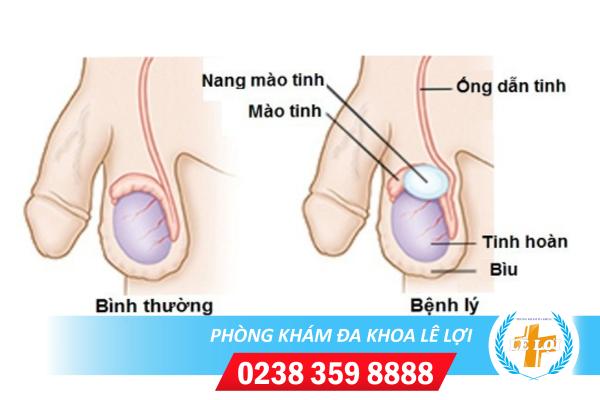 Viêm nang mào tinh hoàn là bệnh như thế nào?