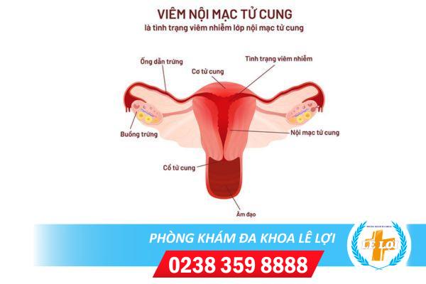 Viêm nội mạc tử cung là gì ? nguy hiểm không ?