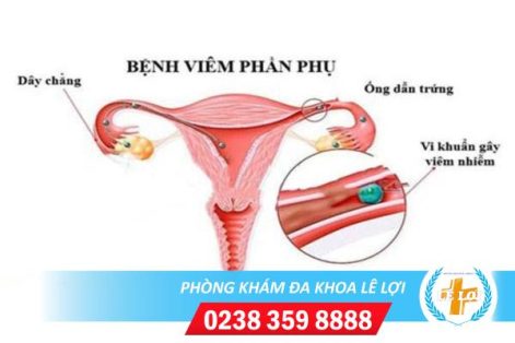 Viêm phần phụ là gì? Những dấu hiệu dễ nhận biết