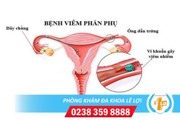 Viêm phần phụ là gì? Những dấu hiệu dễ nhận biết