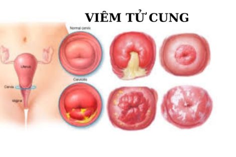 Những triệu chứng bệnh viêm tử cung chị em nên biết