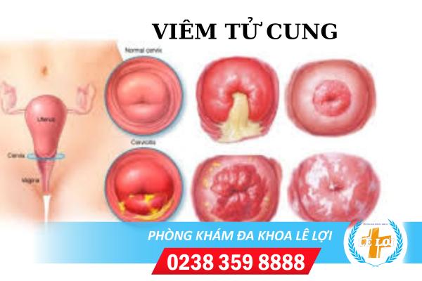 Những triệu chứng bệnh viêm tử cung chị em nên biết