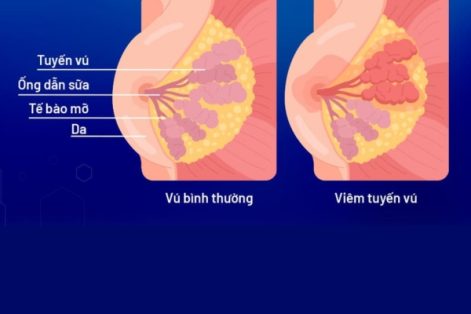 Viêm tuyến vú là gì ?