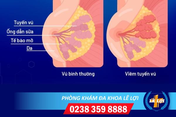 Viêm tuyến vú là gì ?