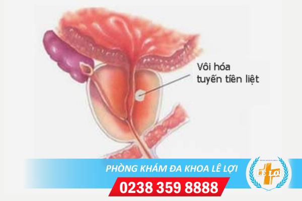 Hỗ trợ điều trị vôi hóa tuyến tiền liệt tại Đa Khoa Lê Lợi