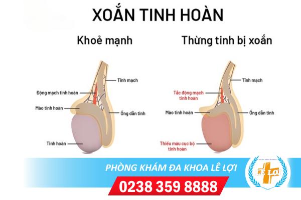 Xoắn tinh hoàn – triệu chứng bệnh nam khoa rất nguy hiểm