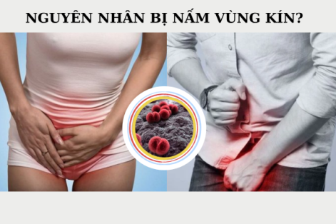 Nấm vùng kín ở nam và nữ