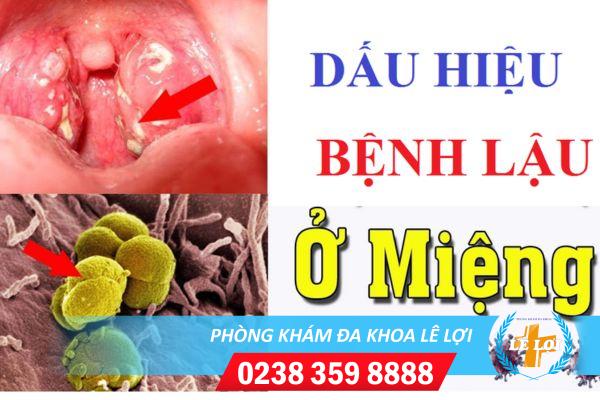 Phương pháp hỗ trợ điều trị bệnh lậu ở miệng