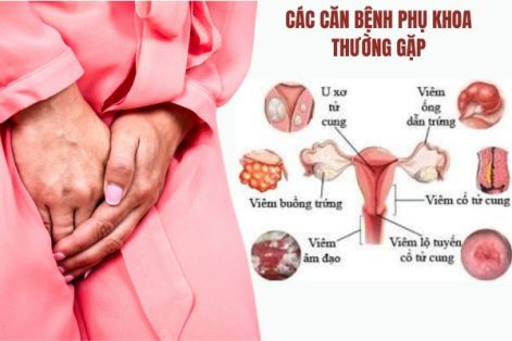 Dấu hiệu nhận biết bệnh phụ khoa