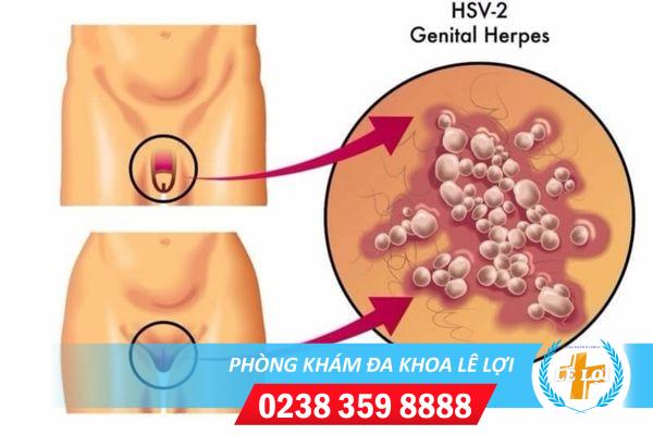 cach-chua-benh-herpes-1