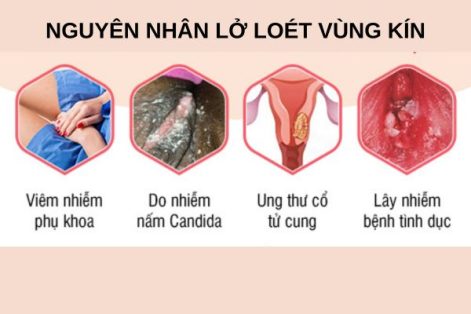 Lở loét vùng bẹn và háng là bệnh gì ?