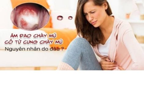 Âm đạo chảy mủ, cổ tử cung chảy mủ nguyên nhân do đâu, cách chữa thế nào?