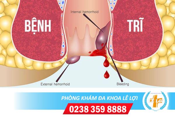 Bệnh trĩ có nguy hiểm không?