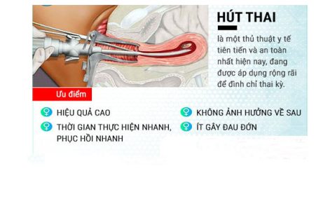 Phá thai bằng kỹ thuật hút thai chân không