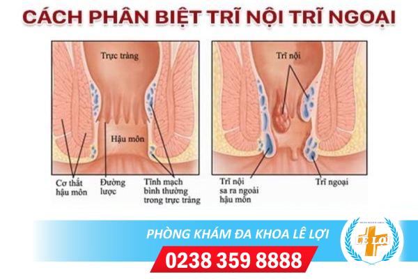 Phân biệt trĩ nội, trĩ ngoại như thế nào?
