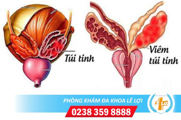 Viêm túi tinh chữa như thế nào ?