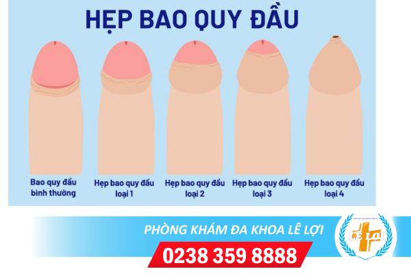 Hẹp bao quy đầu một trong những bệnh lý thường gặp ở nam giới