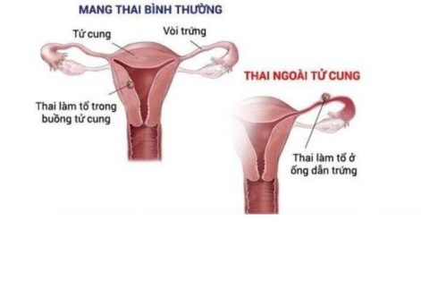 Dấu hiệu nào cho thấy bạn đang mang thai ngoài tử cung?