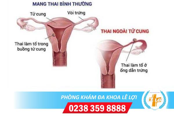 Dấu hiệu nào cho thấy bạn đang mang thai ngoài tử cung?