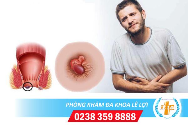 Bệnh trĩ nội là gì? Cách phát hiện sớm bệnh trĩ nội
