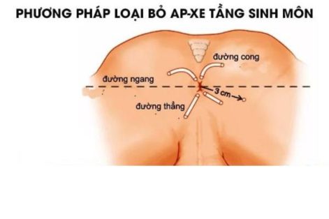 Phương pháp loại bỏ ap-xe tầng sinh môn – Liệu trình một lần duy nhất